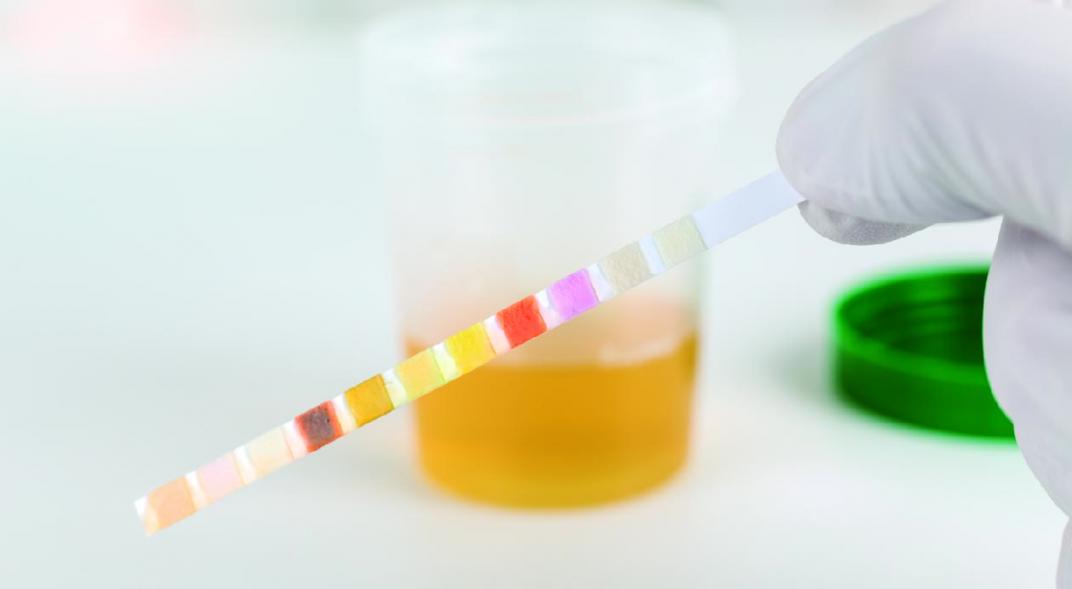 cálculos renales en verano