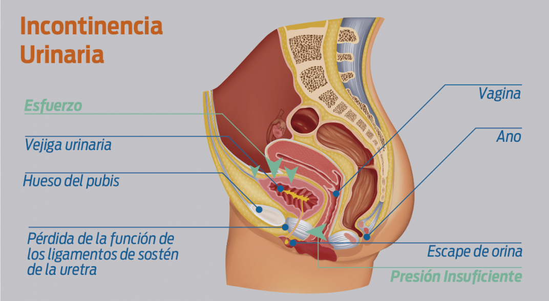 incontinencia urinaria