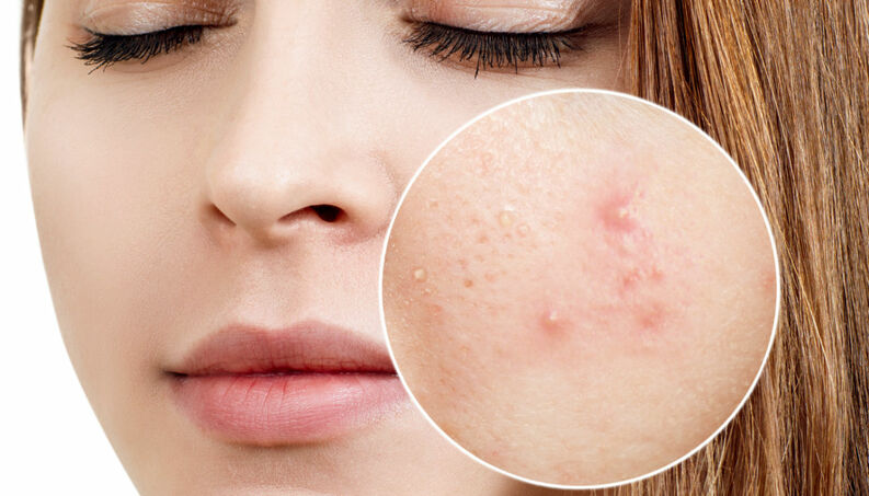 preguntas frecuentes sobre el acné