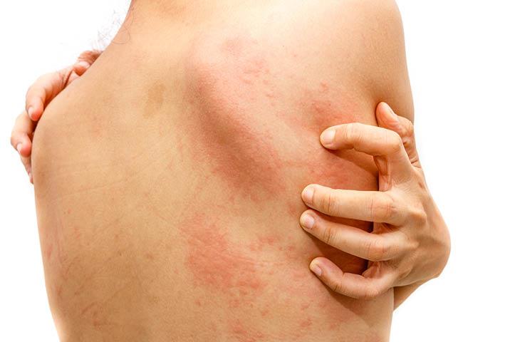 dermatitis en primavera