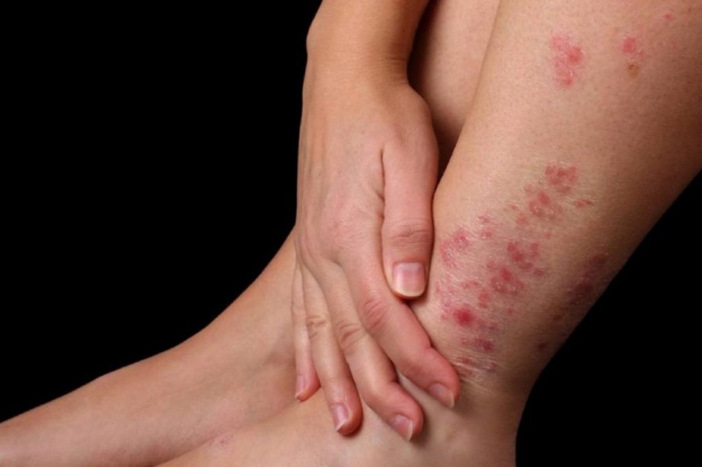 psoriasis enfermedad crónica