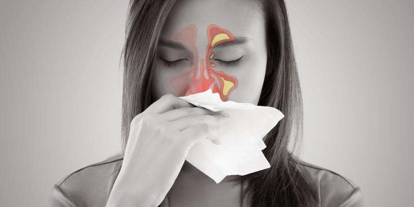 sinusitis aguda
