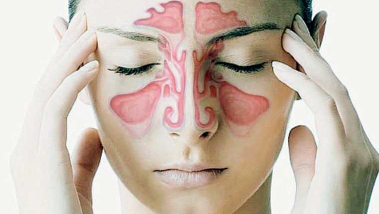 sinusitis aguda