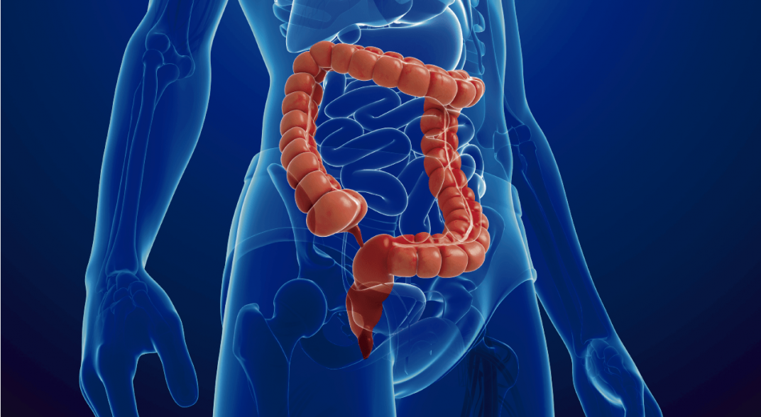 cáncer de colon diagnóstico