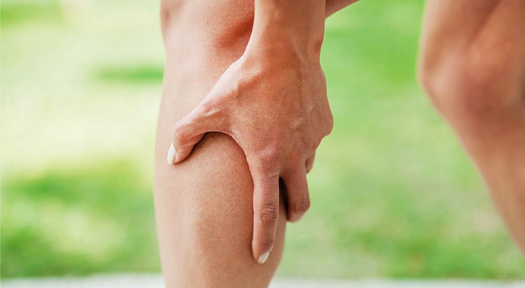 várices y arañas vasculares