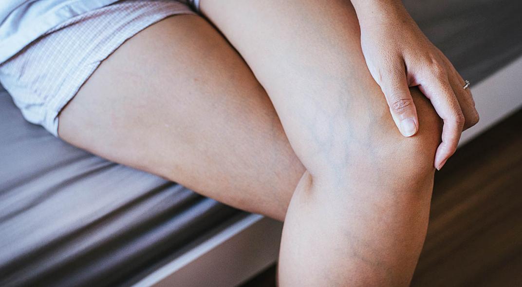 várices y arañas vasculares