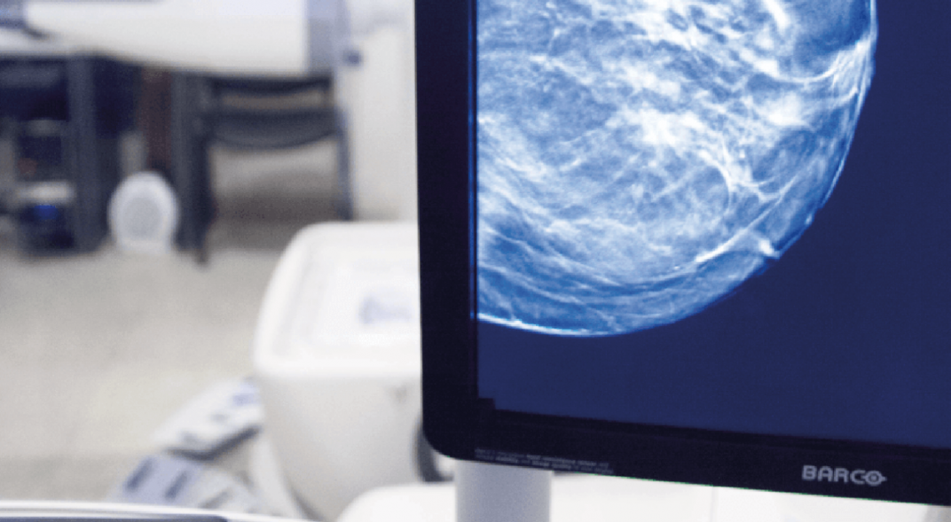mamografía con tomosíntesis