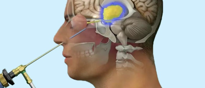 cirugía endoscópica nasal