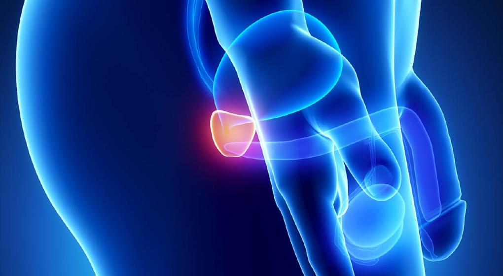 cáncer de próstata