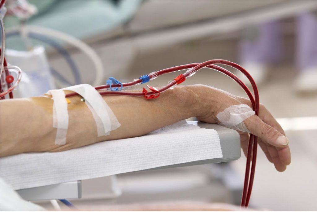 ECMO