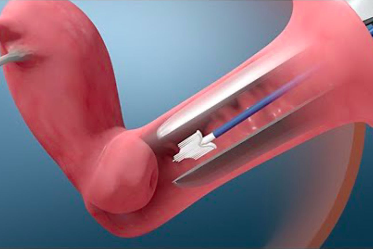 test molecular hpv para detección precoz de cancer uterino sanatorio allende