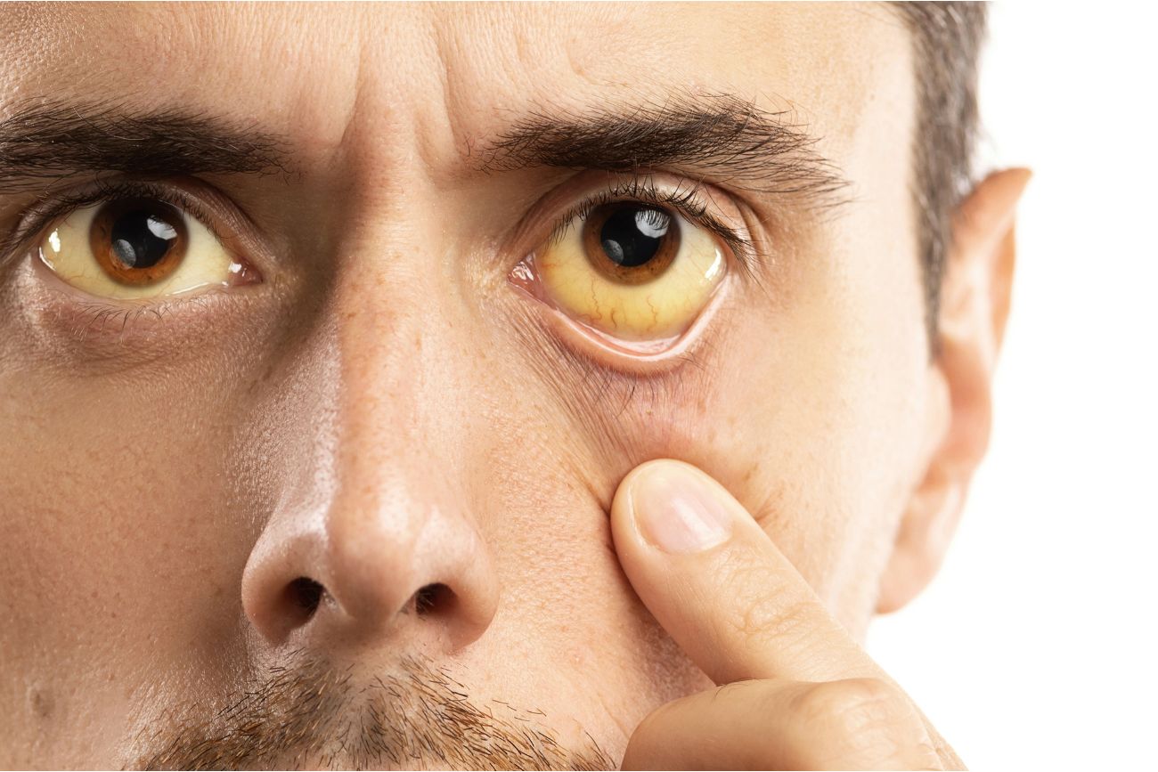 uno de los sintomas de la hepatitis viral es el color amarillo tanto de la piel como de los ojos