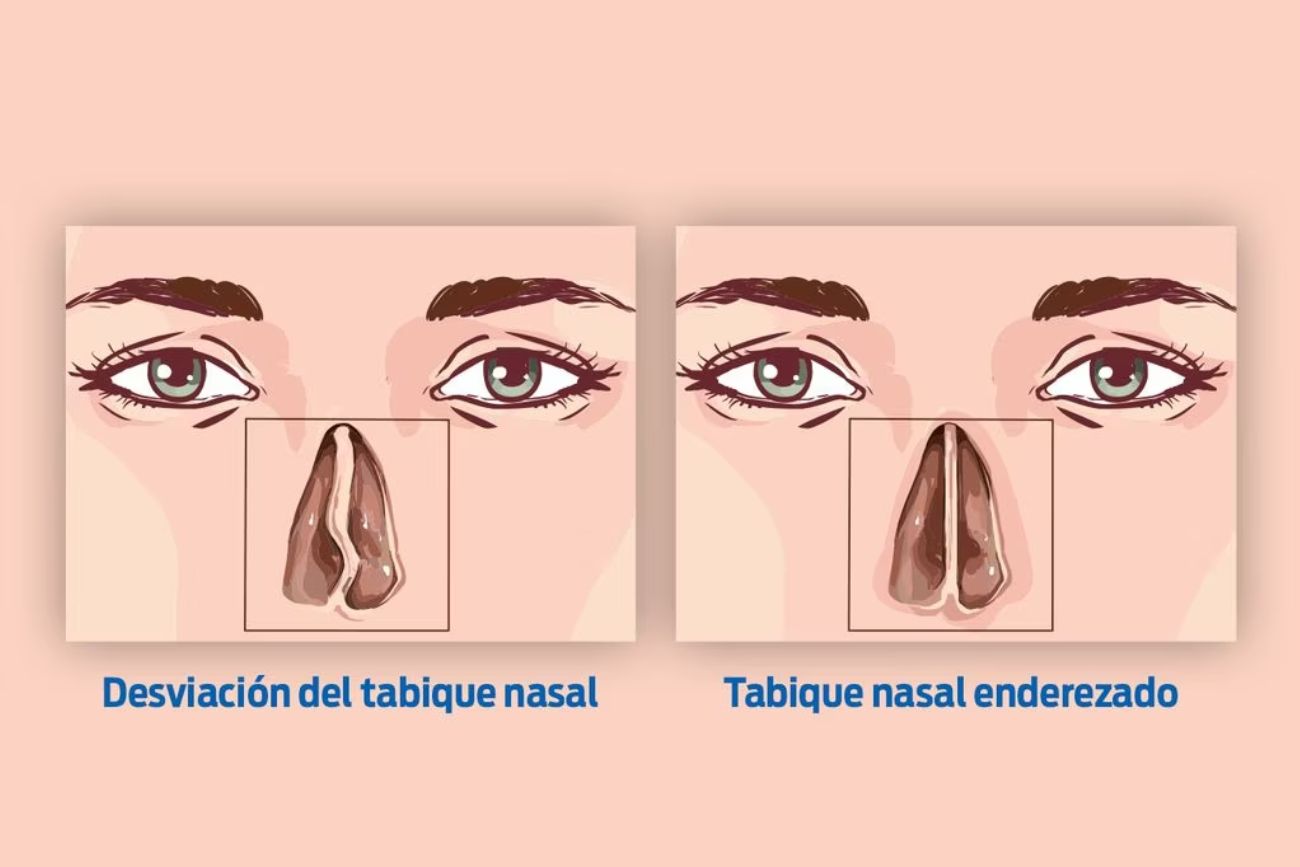 la septoplastia suele ser acompañada por la reducción con radiofrecuencia, del tamaño de los cornetes inferiores para que la mejoría en la obstrucción nasal sea significativa