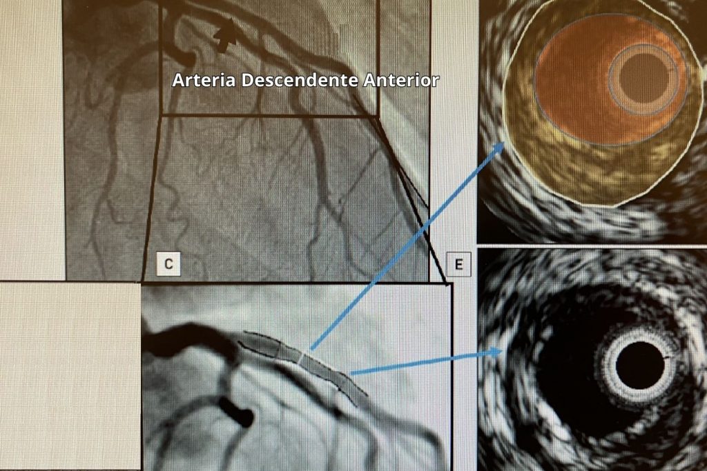 Esta capacidad de IVUS se ha utilizado en estudios clínicos para seguir la progresión/regresión de las placas coronarias.