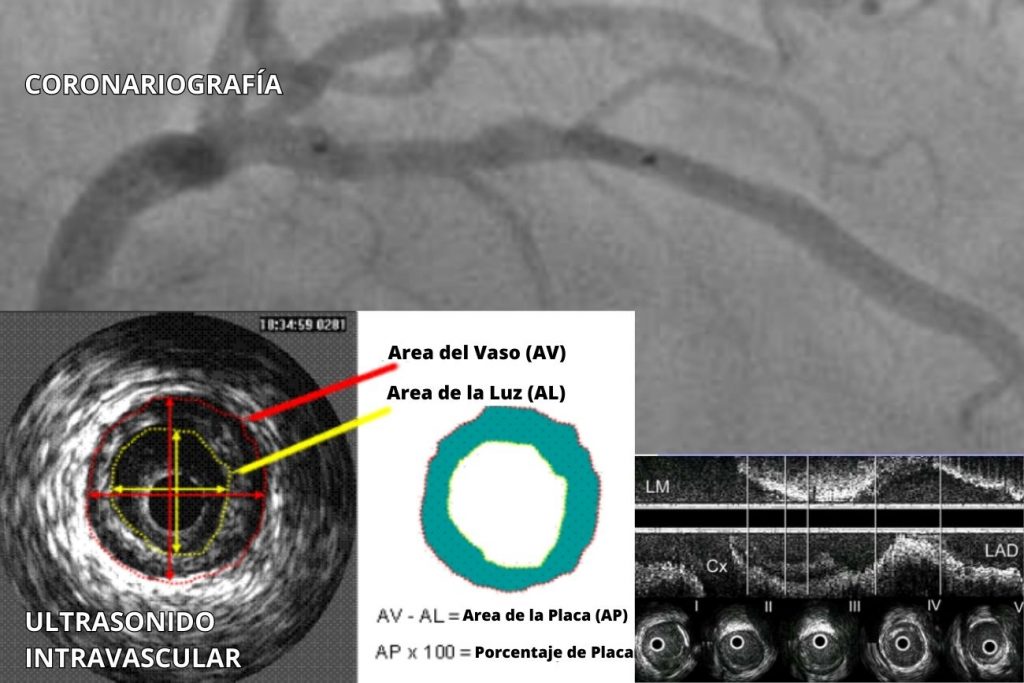 La imagen del IVUS es el resultado de ondas de ultrasonido reflejadas que se convierten en señales eléctricas y se envían a un sistema de procesamiento externo para amplificación, filtrado y conversión de escaneo.