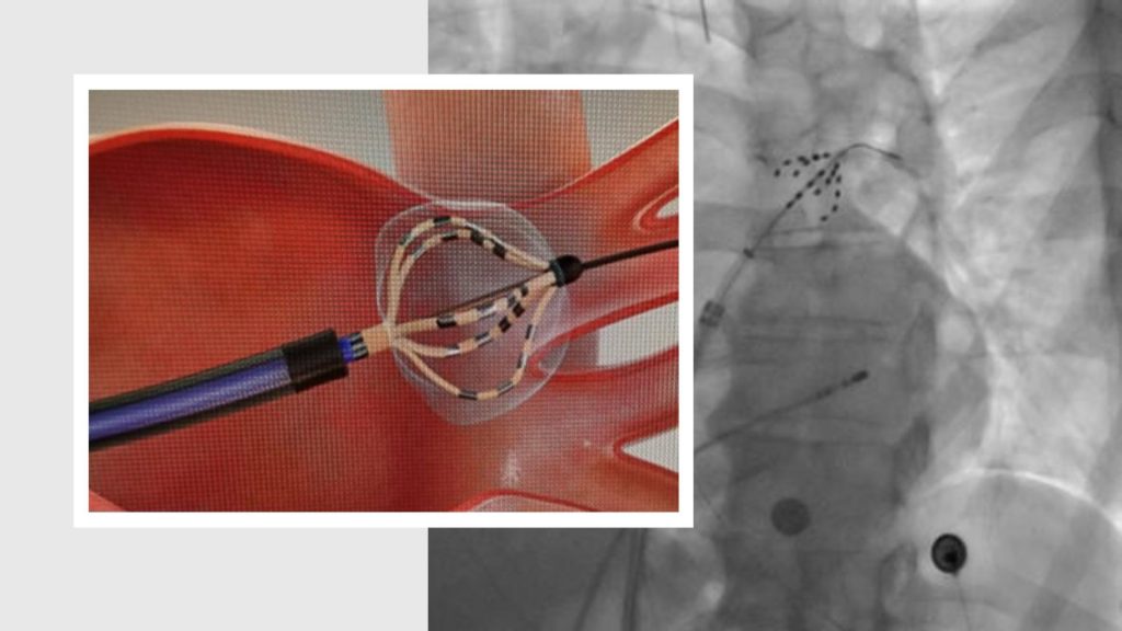 ablacion por campo pulsado