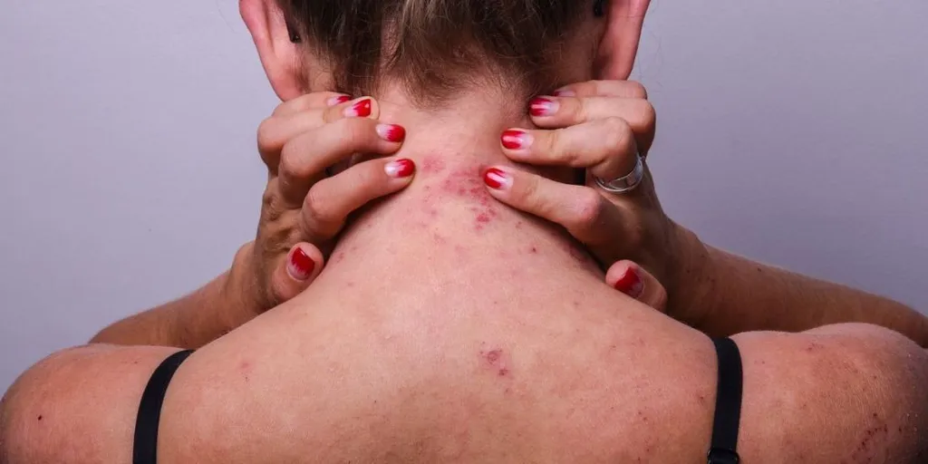 Tratamiento para dermatitis atópica: ¿sirven las cremas para la piel?