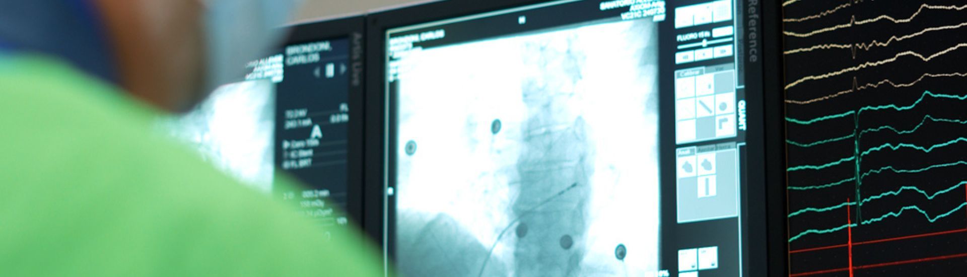  Ablación por campo pulsado: realizamos por primera vez en Córdoba este innovador tratamiento para la fibrilación auricular