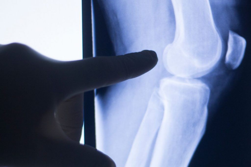 La estructura que reemplazará la rodilla está conformada por rótula (polietileno), inserto (polietileno), componente femoral (metálico) y bandeja tibial (metálico).