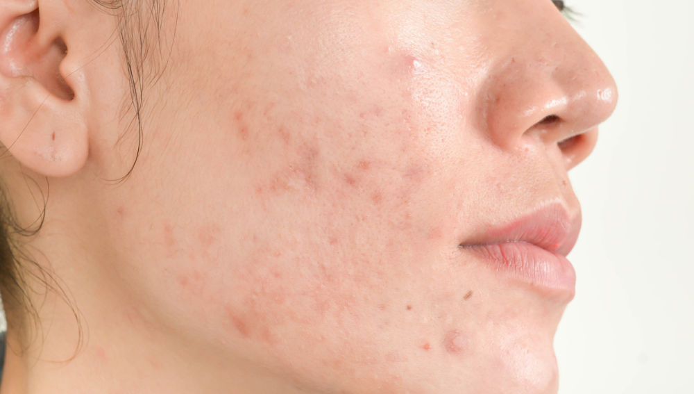preguntas frecuentes sobre el acné