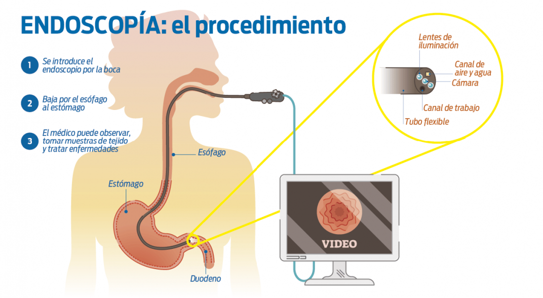 endoscopía
