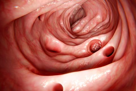 diverticulosis