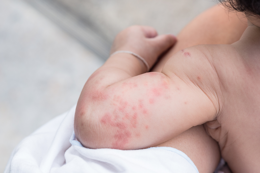 alergia a la proteína de leche de vaca